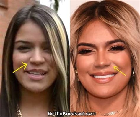 Karol G Plastic Surgery Comparison Photos